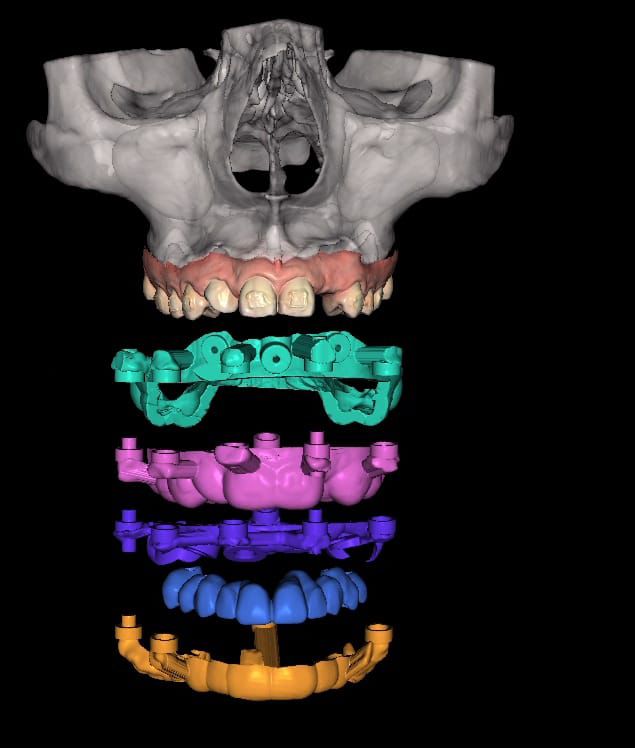 Implantes dentales en Nicaragua con tecnología de alto Nivel
